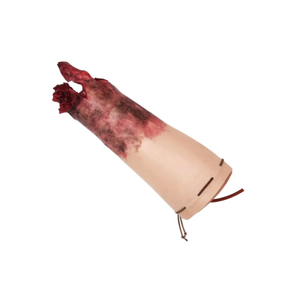 ТРАВМАТИЧНА АМПУТАЦІЯ РУКИ, AA-01-BC